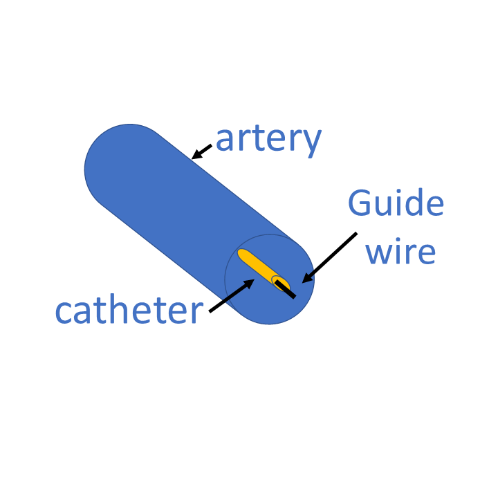 catheter alpha min 1