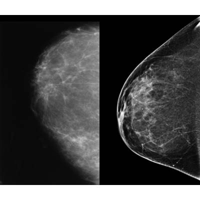 mammographyTomo min