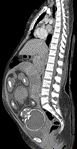 Helical CT